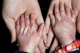 آمریکا در پرونده "تحریم کودکان پروانه ای" محکوم شد