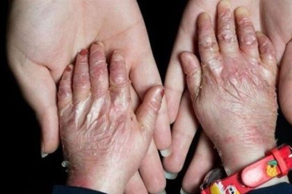آمریکا در پرونده "تحریم کودکان پروانه ای" محکوم شد