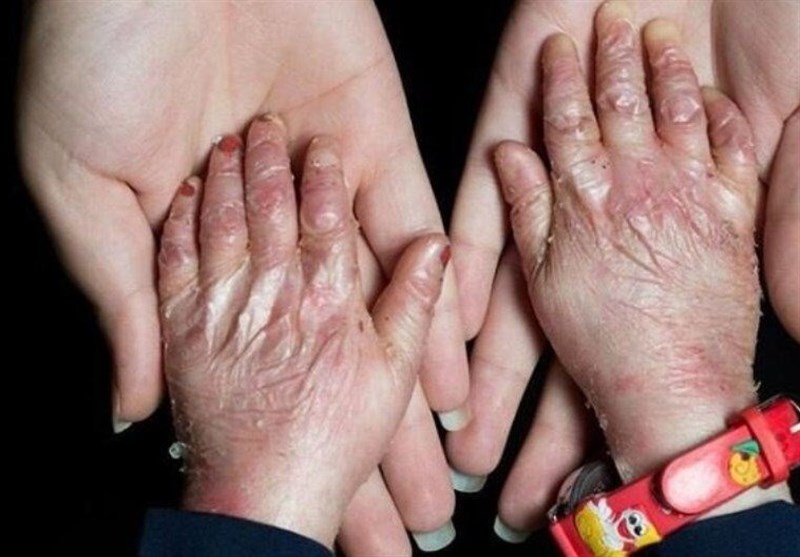 آمریکا در پرونده "تحریم کودکان پروانه ای" محکوم شد