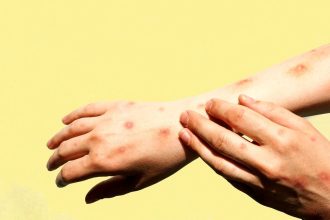 توزیع واکسن آبله میمونی