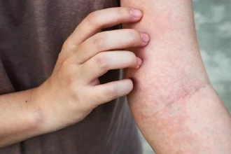 علت خارش شدید شبانه بدن چیست؟