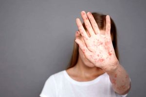 ابتلای هزار نفر به سرخک