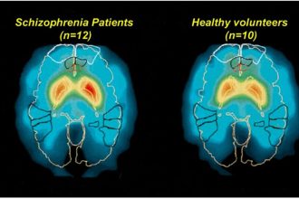 نخستین ابزار تشخیص اسکیزوفرنی با هوش مصنوعی در تایوان معارفه شد_آفتاب شرق 5 تشخیص دقیق اسکیزوفرنی با هوش مصنوعی BrainProbe در تایوان