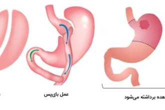 عمل‌های معده که منجر به سندرم دامپینگ می‌شوند.