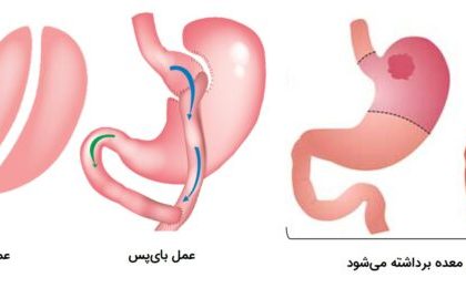 عمل‌های معده که منجر به سندرم دامپینگ می‌شوند.
