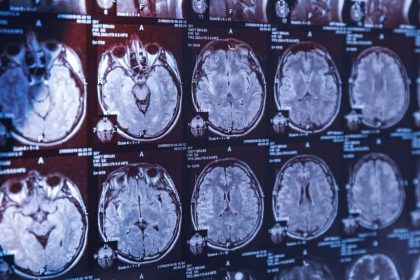 ارتباط آلودگی هوا با خونریزی مغزی