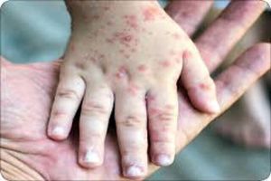 عوارض خطرناک آبله مرغان در بزرگسالی_آفتاب شرق 9 عوارض خطرناک آبله مرغان در بزرگسالی