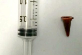 ۴۰ سال یک اسباب‌بازی در ریه!