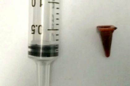 ۴۰ سال یک اسباب‌بازی در ریه!