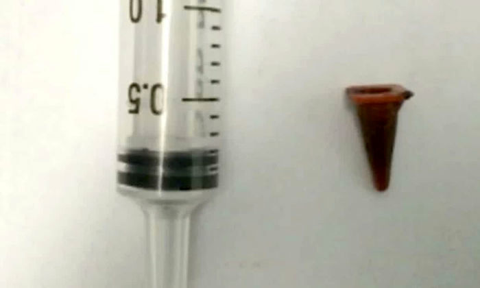 ۴۰ سال یک اسباب‌بازی در ریه!