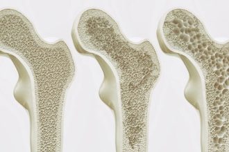 معکوس‌کردن پوکی استخوان