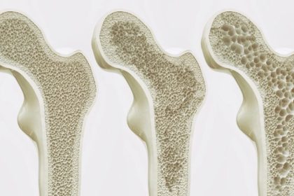 معکوس‌کردن پوکی استخوان