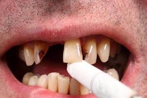 دندان سیگاری ها ۴ برابر افراد دیگر خراب می‌شود