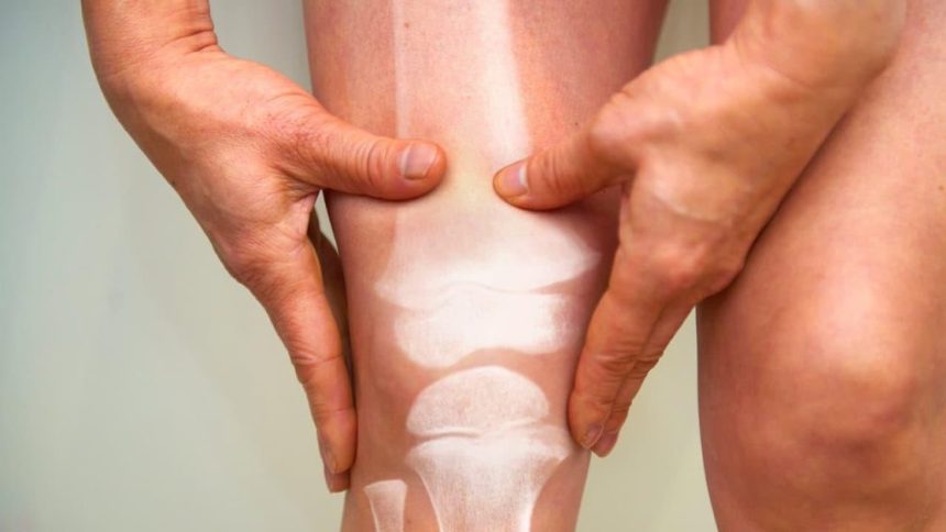 کاهش درد آرتروز