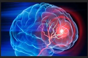 ۴ ساعت نخست؛ زمان طلایی نجات بیماران سکته مغزی_آفتاب شرق 8 ۴ ساعت نخست؛ زمان طلایی نجات بیماران سکته مغزی