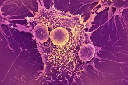 سرطان و تومور