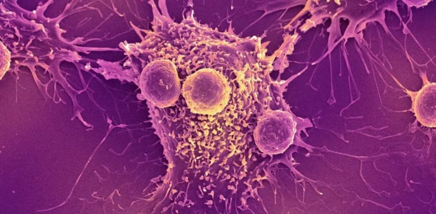 سرطان و تومور