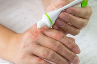 موارد ابتلا به «پسوریازیس» در جهان افزایش یافت