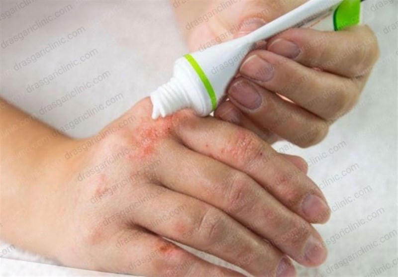 موارد ابتلا به «پسوریازیس» در جهان افزایش یافت