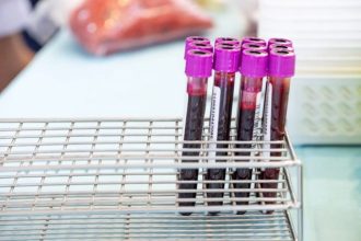 آزمایش خون آلزایمر