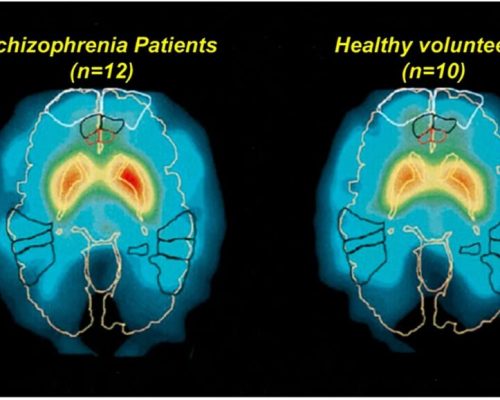 تشخیص دقیق اسکیزوفرنی با هوش مصنوعی BrainProbe در تایوان