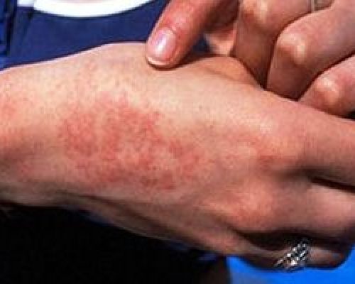 ابتلای بیش از ۱۹ هزار نفر به تب مالت در ایران