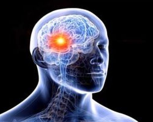 شایع ترین علت خونریزی مغزی را بشناسیم