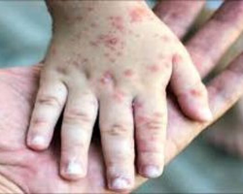 عوارض خطرناک آبله مرغان در بزرگسالی