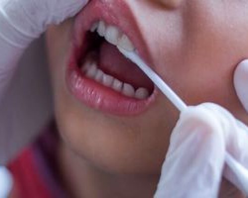 «فیشور سیلنت»؛ روشی مؤثر برای پیشگیری از پوسیدگی دندان کودکان
