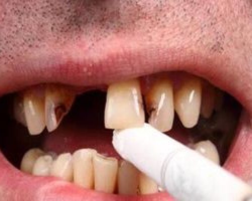 دندان سیگاری ها ۴ برابر افراد دیگر خراب می‌شود