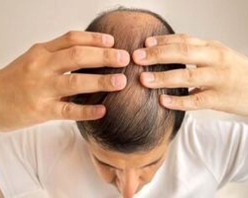 این داروی درمان ریزش مو باعث ایجاد افکار خودکشی می‌شود