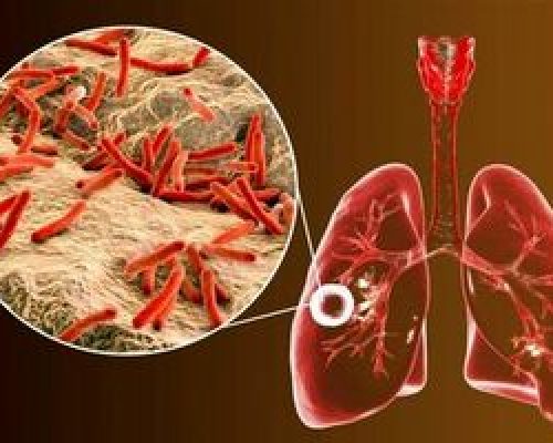 ابتلای ۶ هزار ایرانی به یک بیماری خطرناک ریوی/ ۸ استان در صدر شیوع بیماری