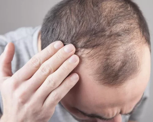 ریزش مو در اثر استرس