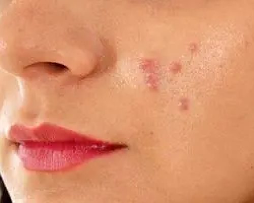 این مواد غذایی باعث بروز آکنه و جوش می‌شوند
