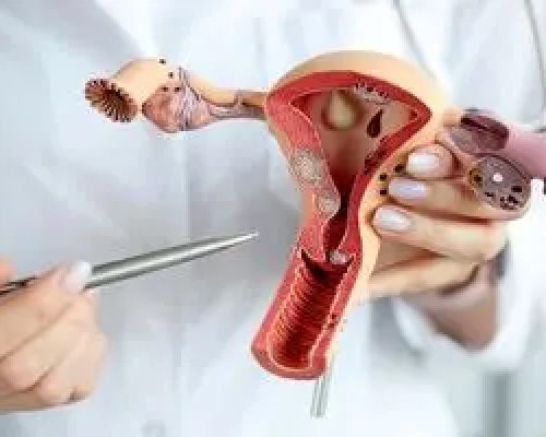 تشخیص دیرهنگام آندومتریوز؛ تهدیدی برای باروری زنان