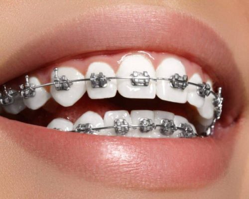 7 موقعیت واقعی که نشان می‌دهد شاید وقت بررسی ارتودنسی شما رسیده باشد