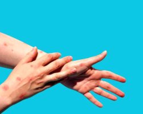 آیا احتمال شیوع آبله میمونی در ایران وجود دارد؟