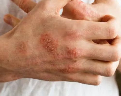 راش پوستی قرمز و ناهموار از علائم تب روماتیسمی