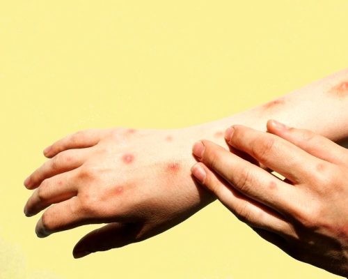 توزیع واکسن آبله میمونی