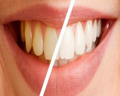 جرم گیری هیچ تاثیر منفی بر مینا و ریشه دندان ها ندارد