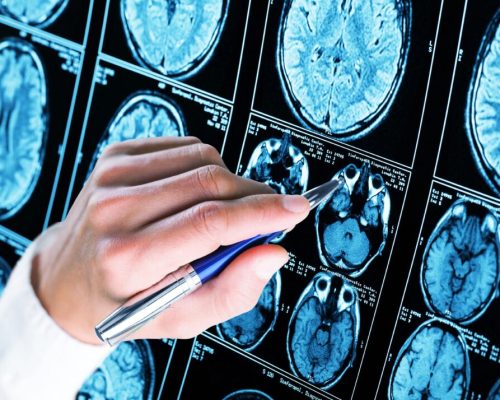 خطر ابتلا به زوال عقل با کمبود ویتامین D و افسردگی افزایش می‌یابد