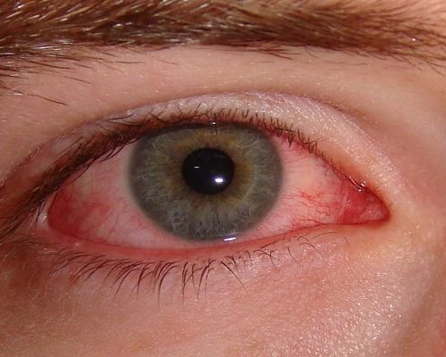 قرمزی چشم از علائم سندرم شوک سمی