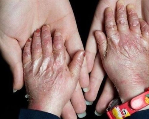سهمیه تابستان پانسمان های تخصصی به خانه EB تحویل شد