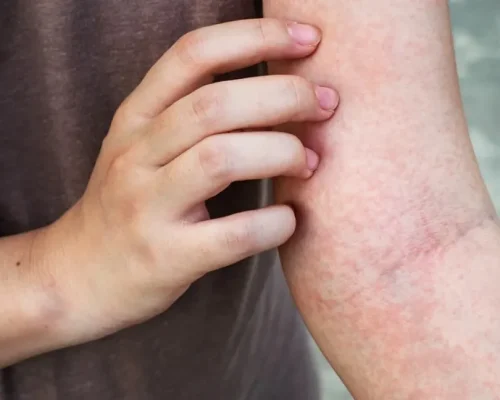 علت خارش شدید شبانه بدن چیست؟