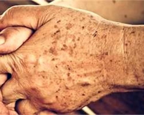 لکه ها پوستی از کجا می آیند؟